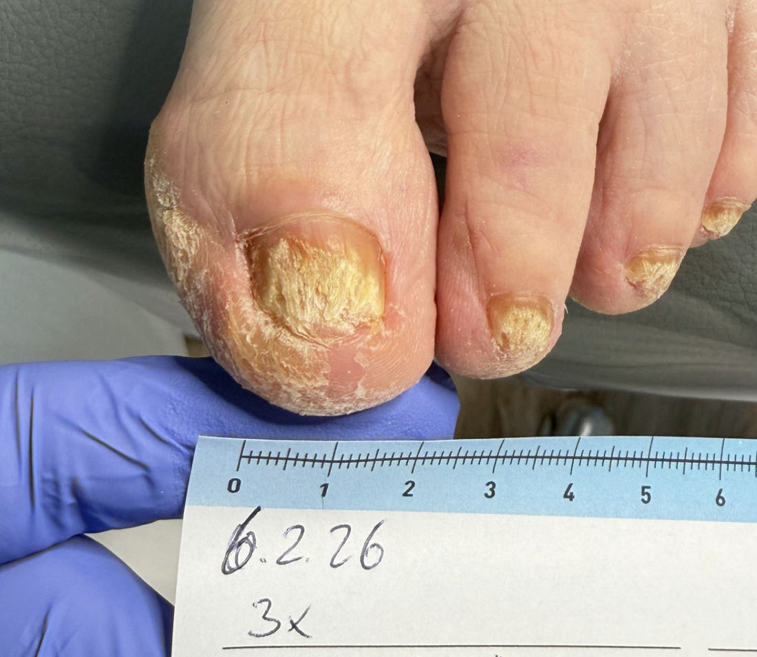 Nagelpilz (Onychomykose) erkennen und behandeln leitliniengerecht, wirksam, nachhaltig